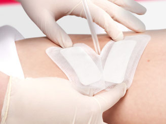 CUTIMED SORBION SACHET S DRAINAGE, Superabsorbierende Wundauflage in geschlitzer Form